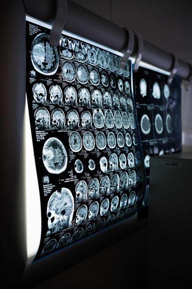 Computertomografie Gehirn