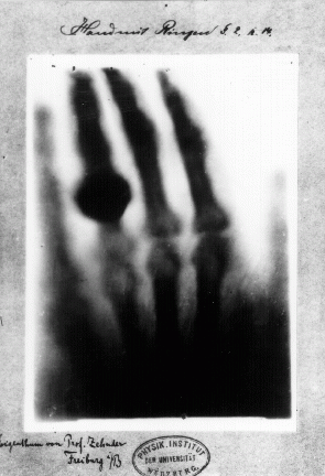 Eine der ersten bekannten Röntgenaufnahme: die Handknochen der Frau Wilhelm Röntgens, Anna Bertha, mitsamt Ring. 