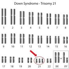 Trisomie 21