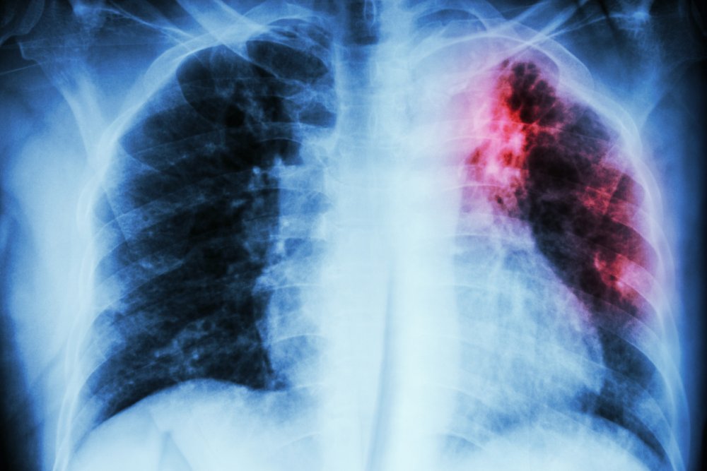 Tuberkulose Lunge
